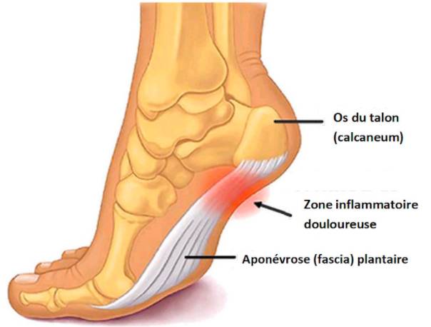 Trail quelle chaussure pour courir avec une aponevrosite