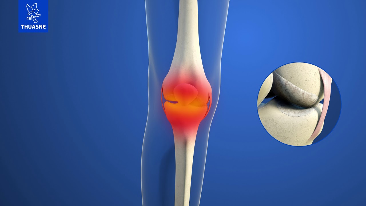 Soulager l'arthrose du genou (gonarthrose) : genouillère arthrose